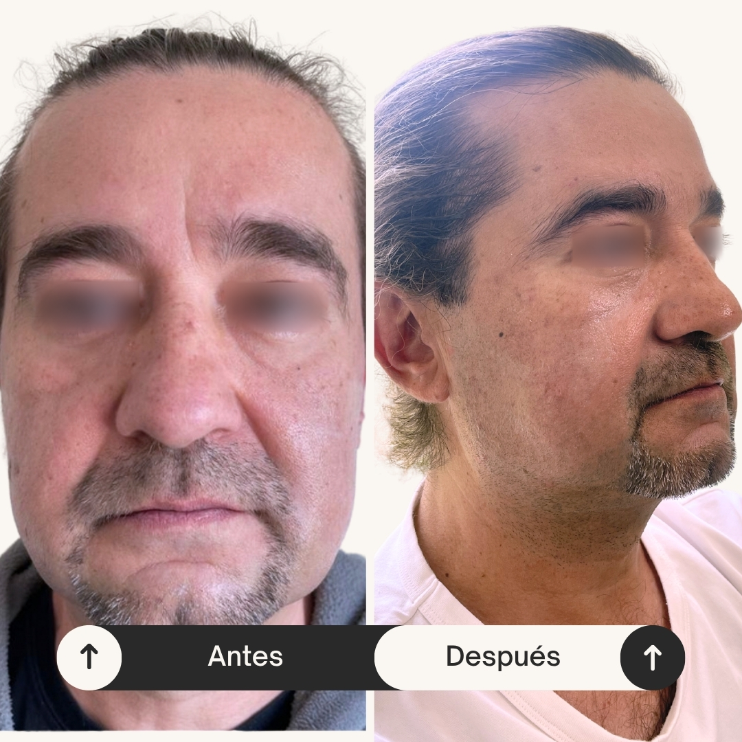 Antes y después del caso con seguimiento de tres años, con ojos difuminados
