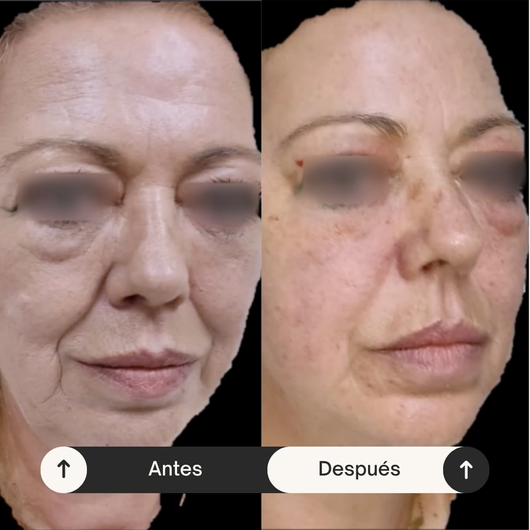 Antes y después del caso de seis sesiones, con ojos difuminados