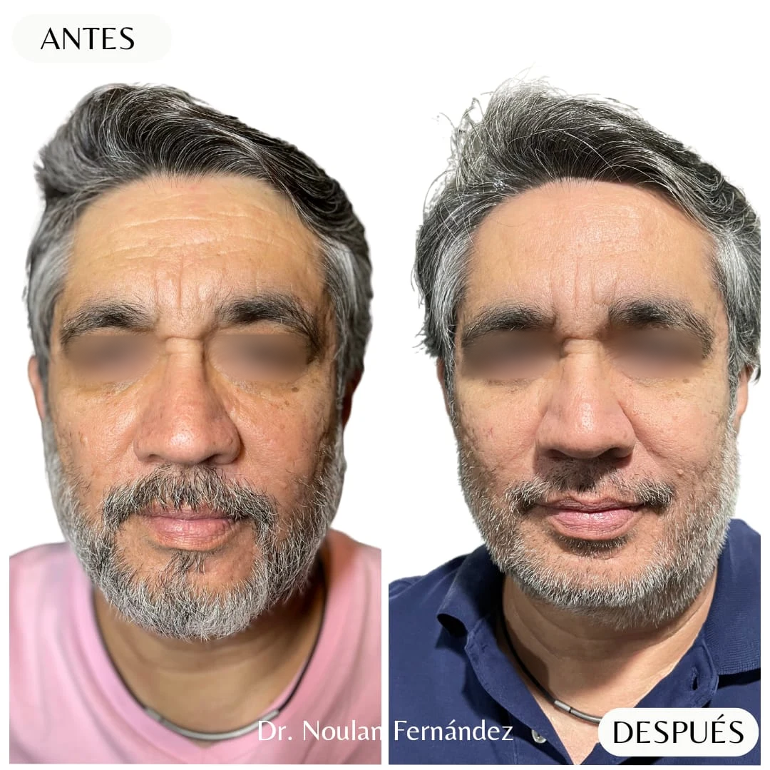 Comparación clínica aportada por el Dr. Nou: antes a la izquierda y después a la derecha, paciente masculino