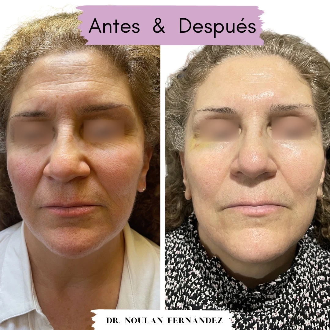 Comparación clínica de paciente con ojos ocultos: antes a la izquierda y después a la derecha