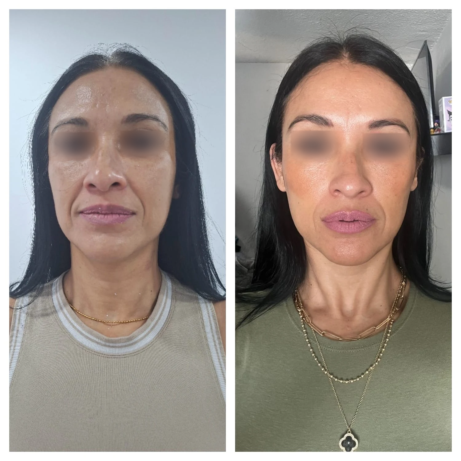 Comparación fotográfica aportada por el Dr. Nou, dos momentos de una paciente